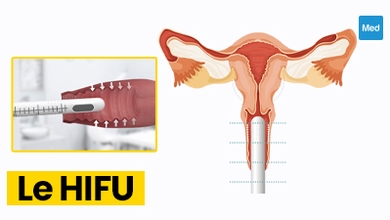 HIFU gynécologique : une nouvelle technique prometteuse