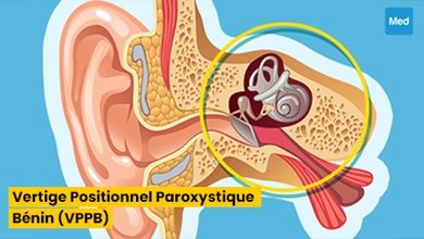 Vertige Positionnel Paroxystique Benin (VPPB) 