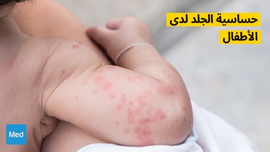 حساسية الجلد لدى الأطفال