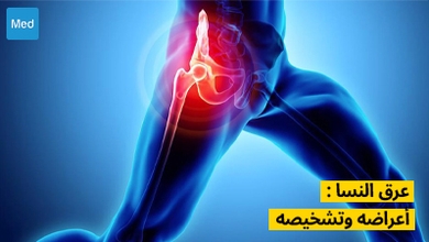 عرق النسا : أعراضه وتشخيصه