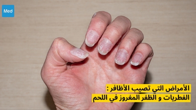 الأمراض التي تصيب الأظافر : الفطريات و الظفر المغروز في اللحم