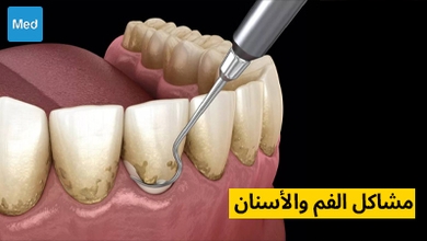 مشاكل الفم والأسنان 