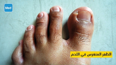 الظفر المنغرس في اللحم