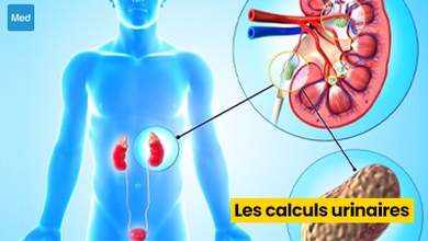 Les calculs urinaires : causes, symptômes et traitements