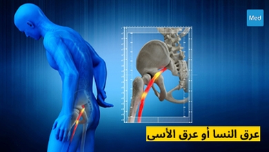 عرق النسا أو عرق الأسى