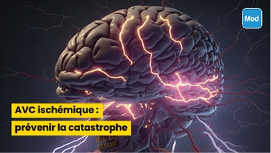 AVC ischémique : prévenir la catastrophe
