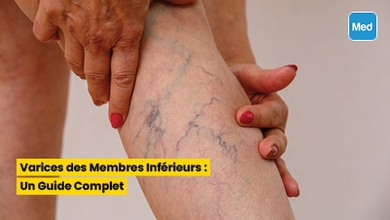 Varices des Membres Inférieurs : Un Guide Complet