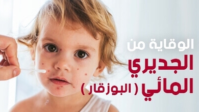  الوقاية من الجديري المائي ( البوزقار )