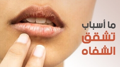 ما أسباب تشقق الشفاه