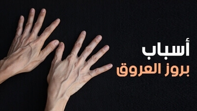 أسباب بروز العروق