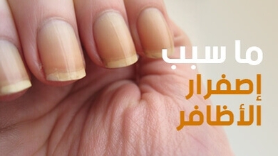 ما  سبب إصفرار الأظافر