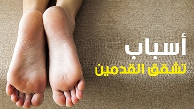 أسباب تشقق القدمين