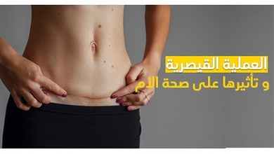 العملية القيصرية و تأثيرها على صحة الأم