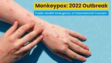 Monkeypox: 2022 Outbreak