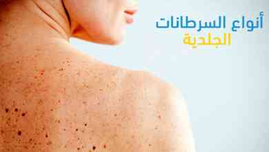 أنواع السرطانات الجلدية