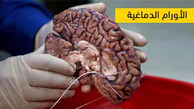 الأورام الدماغية
