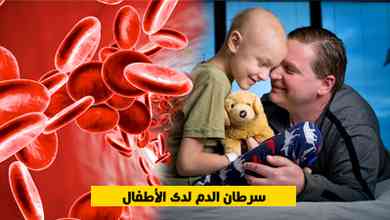 سرطان الدم لدى الأطفال