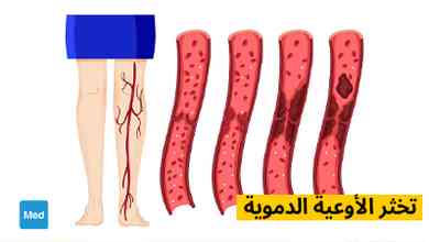 تخثر الأوعية الدموية