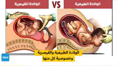 الولادة الطبيعية والقيصرية وخصوصية كل منها
