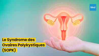 Tout ce que vous devez savoir sur le Syndrome des Ovaires Polykystiques (SOPK)