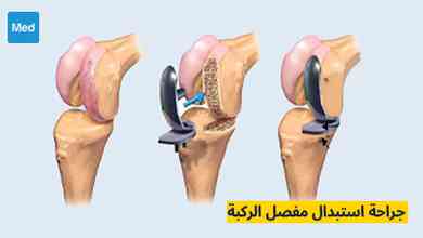جراحة استبدال مفصل الركبة