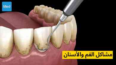 مشاكل الفم والأسنان 