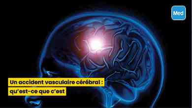 Un accident vasculaire cérébral : qu’est-ce que c’est ?