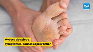 Mycose des pieds : symptômes, causes et prévention