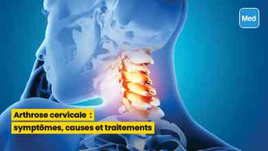 Arthrose cervicale : symptômes, causes et traitements