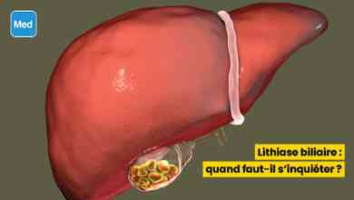 Lithiase biliaire : quand faut-il s