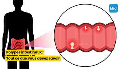 Polypes intestinaux : Tout ce que vous devez savoir