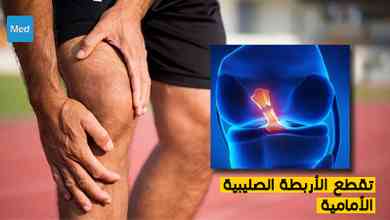 تقطع الأربطة الصليبية الأمامية