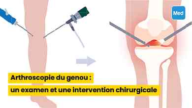 Arthroscopie du genou : un examen et une intervention chirurgicale