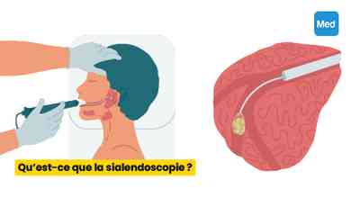 Qu’est-ce que la sialendoscopie ?