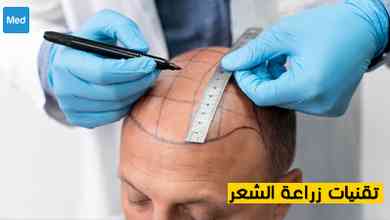 تقنيات زراعة الشعر 