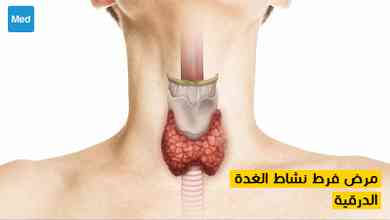 مرض فرط نشاط الغدة الدرقية