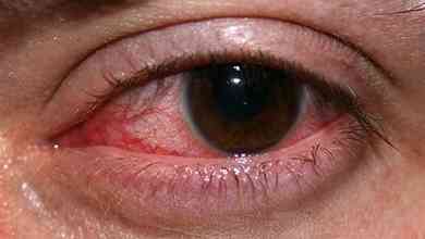 9 أسباب لإحمرار العين
