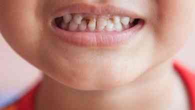 أسباب وأعراض تسوس الأسنان عند الاطفال