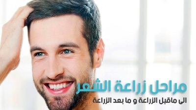 مراحل زراعة الشعر