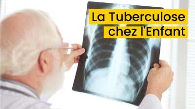 La Tuberculose chez l'Enfant
