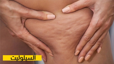 السيلوليت
