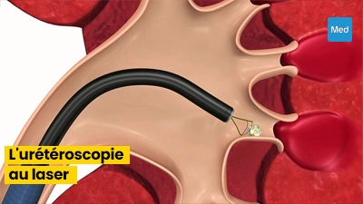 Tout ce que vous devez savoir sur l'urétéroscopie au laser