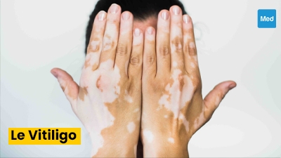Vitiligo : tout ce que vous devez savoir