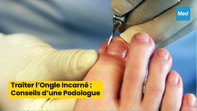 Traiter l'Ongle Incarné : Conseils d'une Podologue