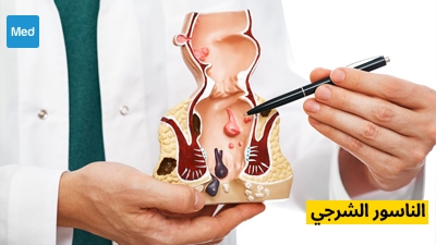 الناسور الشرجي: فهم هذا المرض المؤلم