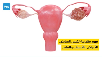 فهم متلازمة تكيس المبايض: الأعراض والأسباب والعلاج