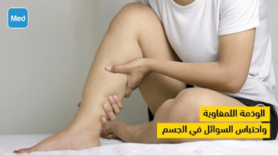 الوذمة اللمفاوية واحتباس السوائل في الجسم