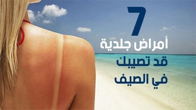 أمراض جلدية قد تصيبك في الصيف 7 