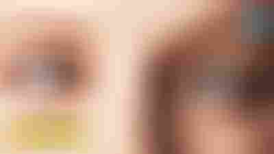 Le strabisme : un trouble oculaire qui mérite d
