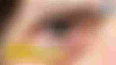 Regard rajeuni : tout savoir sur la Blépharoplastie